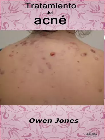 Tratamiento Del Acné